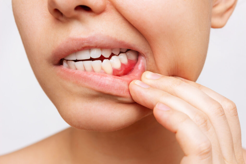 Gum-Disease