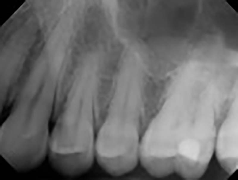 dental tooth x-ray